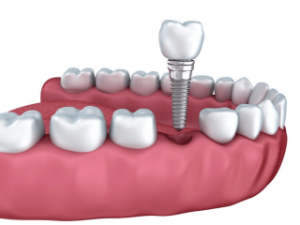 sunshine coast dental implants