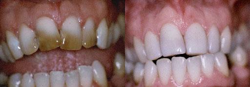 before and after stain kawana dentist