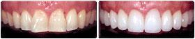 before and after veneers sunshine coast dentistry