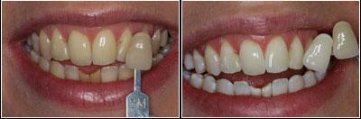 before and after whitening sunshine coast dentist