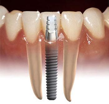 Dental Implants Kawana Dentist