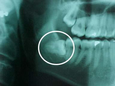 Kawana Dental Wisdom Teeth Extraction