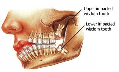 Kawana Dentist Wisdom Teeth Removal